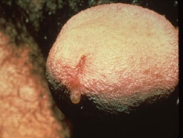 coceira na uretra devido à descarga